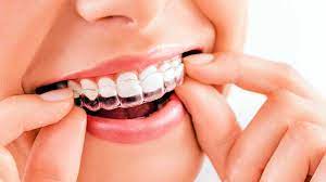 Clear Aligners Market Size, Price, Demand, Outlook 2033